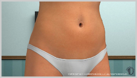 Tummy-Tuck-Full-RECOVERY-AND-RESULTS