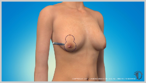 breast-lift-with-implants-SURGERY-PREPARATION