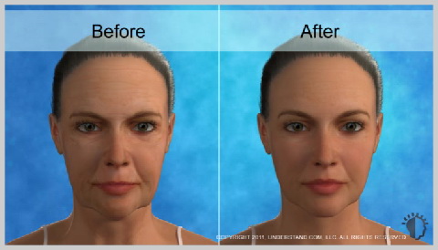 face-lift-full-before-and-after