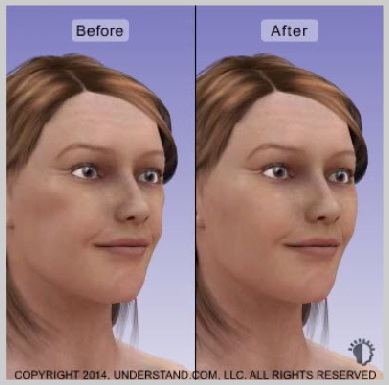 facial-implants-RESULTS