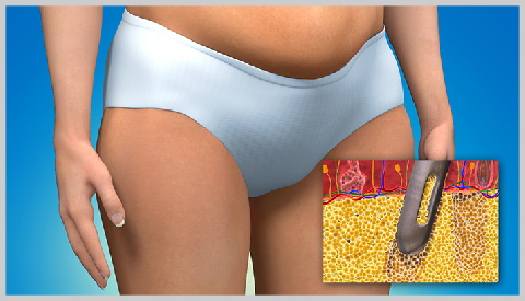 mommy-makeover-LIPOSUCTION-IN-MOMMY-MAKEOVER