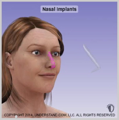 nasal-implants-NASAL-IMPLANTS