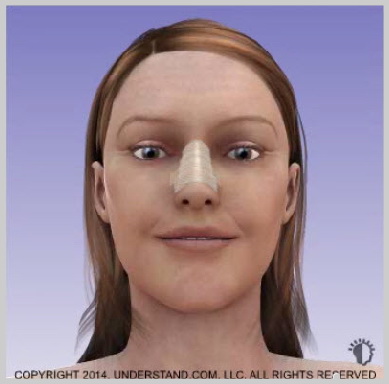 nasal-implants-NASAL-IMPLANTS-RECOVERY