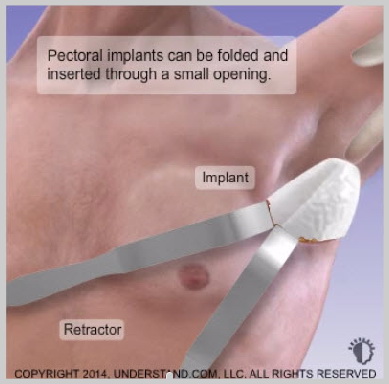pectoral-implants-CHEST-IMPLANT-INSERTION
